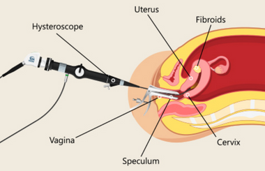 HYSTEROSCOPY